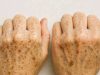 The Truth About Age Spots: When They’re Normal and When to See a Doctor